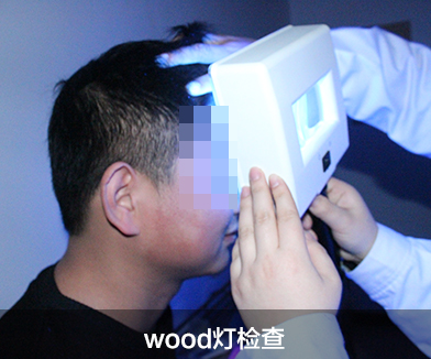 wood灯检查